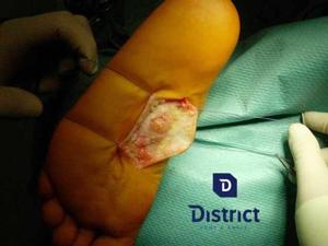 Healing Plantar Fasciitis
