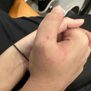 LOVE BITE ❌thumb bite ✅