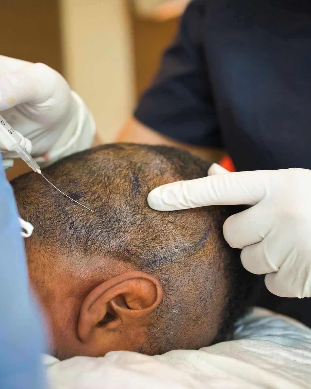 FUE Hair Transplant for Natural Hair Restoration