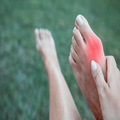 Understanding Bunion Treatment: From Therapy to Surgery in Sydney