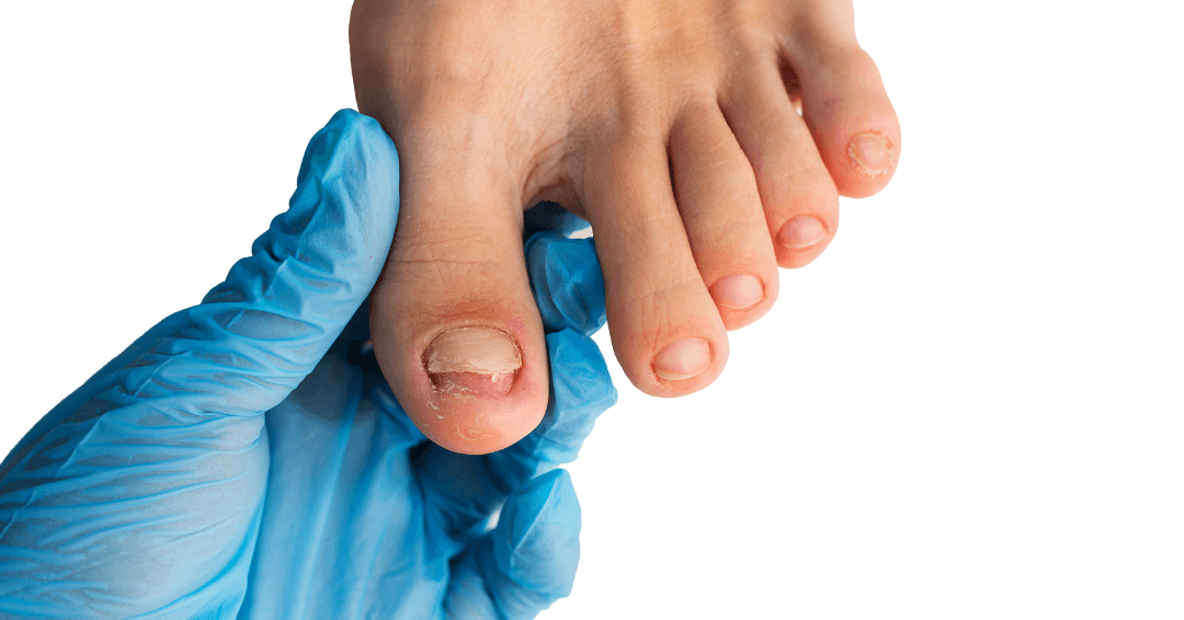 Podiatrist Fungal Nail – Expert Care at Sydney Foot Solutions