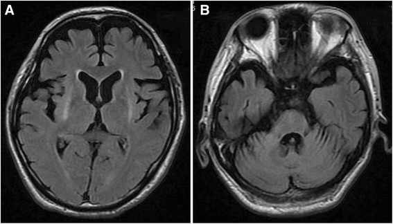Multiple System Atrophy (MSA) Market: Size, Trends, and Growth S