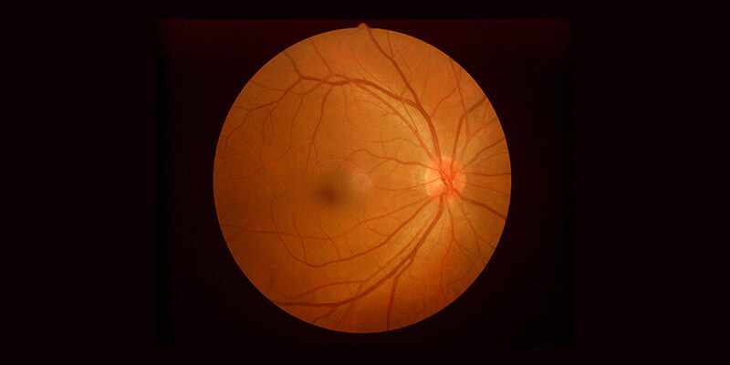 Retinal Vein Occlusion Market Size, Trends, and Strategic Outlook 2025-2032