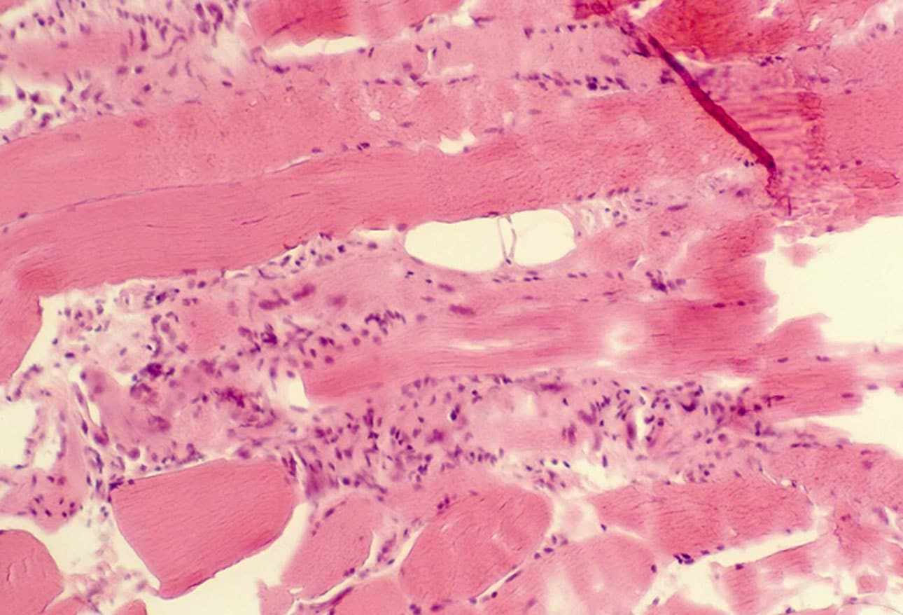 Inclusion Body Myositis Market: Size, Trends, and Strategic Growth Analysis