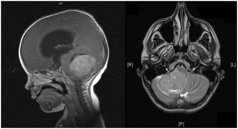 Medulloblastoma Drug Market: Size, Trends, Growth, and Strategic Outlook
