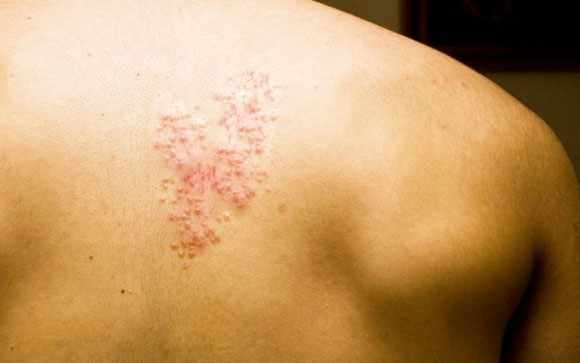 Postherpetic Neuralgia Market Size and Growth Dynamics 2025-2032