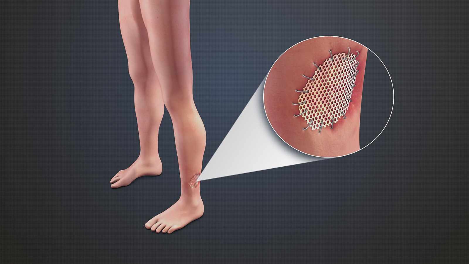 Global Skin Grafting Device Market Growth and Strategic Outlook 2025-2032