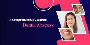 A Comprehensive Guide on Dental Abscess