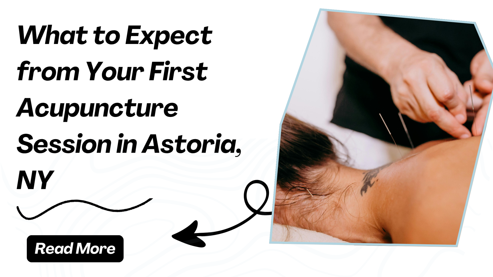 What to Expect from Your First Acupuncture Session in Astoria, NY