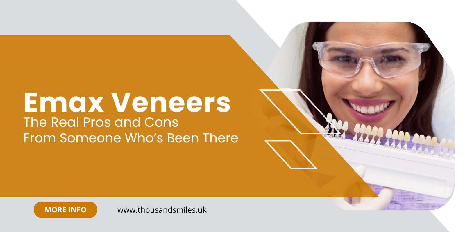 Emax Veneers: The Real Pros and Cons From Someone Who’s Been There