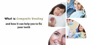 What is composite bonding and how it can help you to fix your teeth