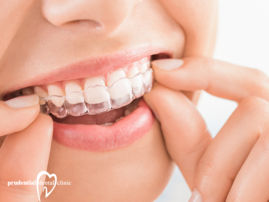 How Orthodontic Clear Aligners Work: A Complete Guide