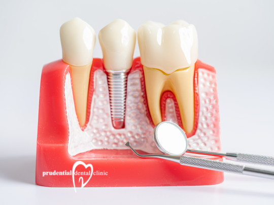 Why Is Root Canal Therapy the Best Choice for Severe Tooth Decay?