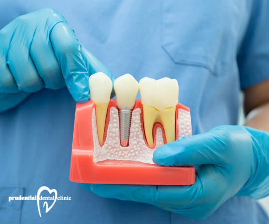 What to Expect During Your Root Canal Therapy in Sydney CBD?