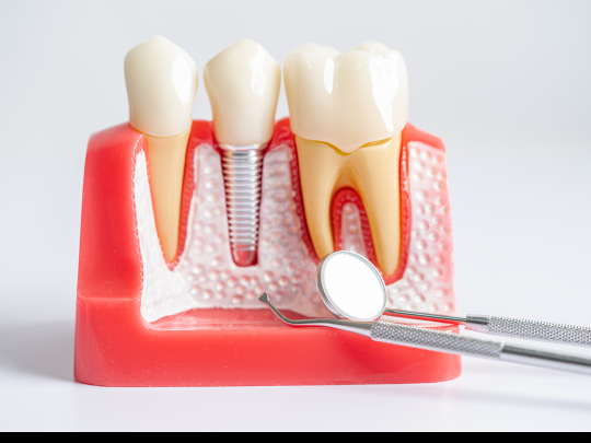 Root Canal Therapy: Step-by-Step Procedure Explained