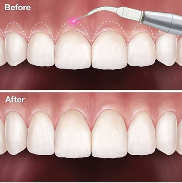 Planning Cosmetic Work? Understand Gum Contouring Cost First