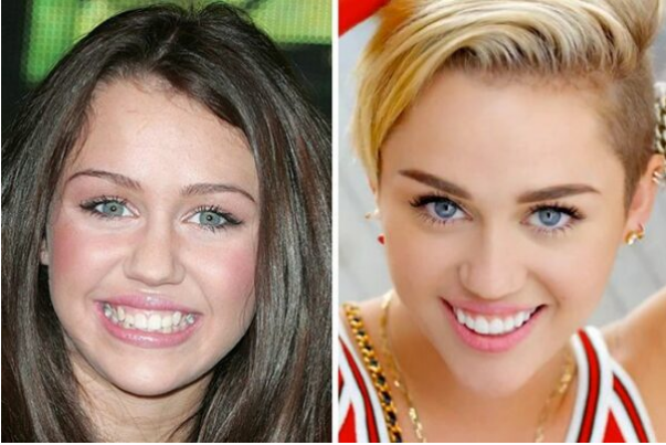 Porcelain Veneers: Pros, Cons, and Process