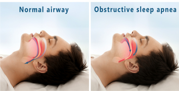 Improve Sleep and Wellness with a Dedicated Sleep Apnea Doctor