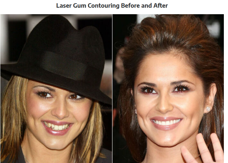 Gum Contouring Cost — What to Expect and What Affects the Price
