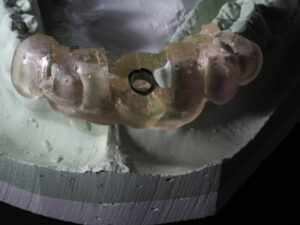 Dental Implants Surgery — A Complete Guide to Restoring Your Smile