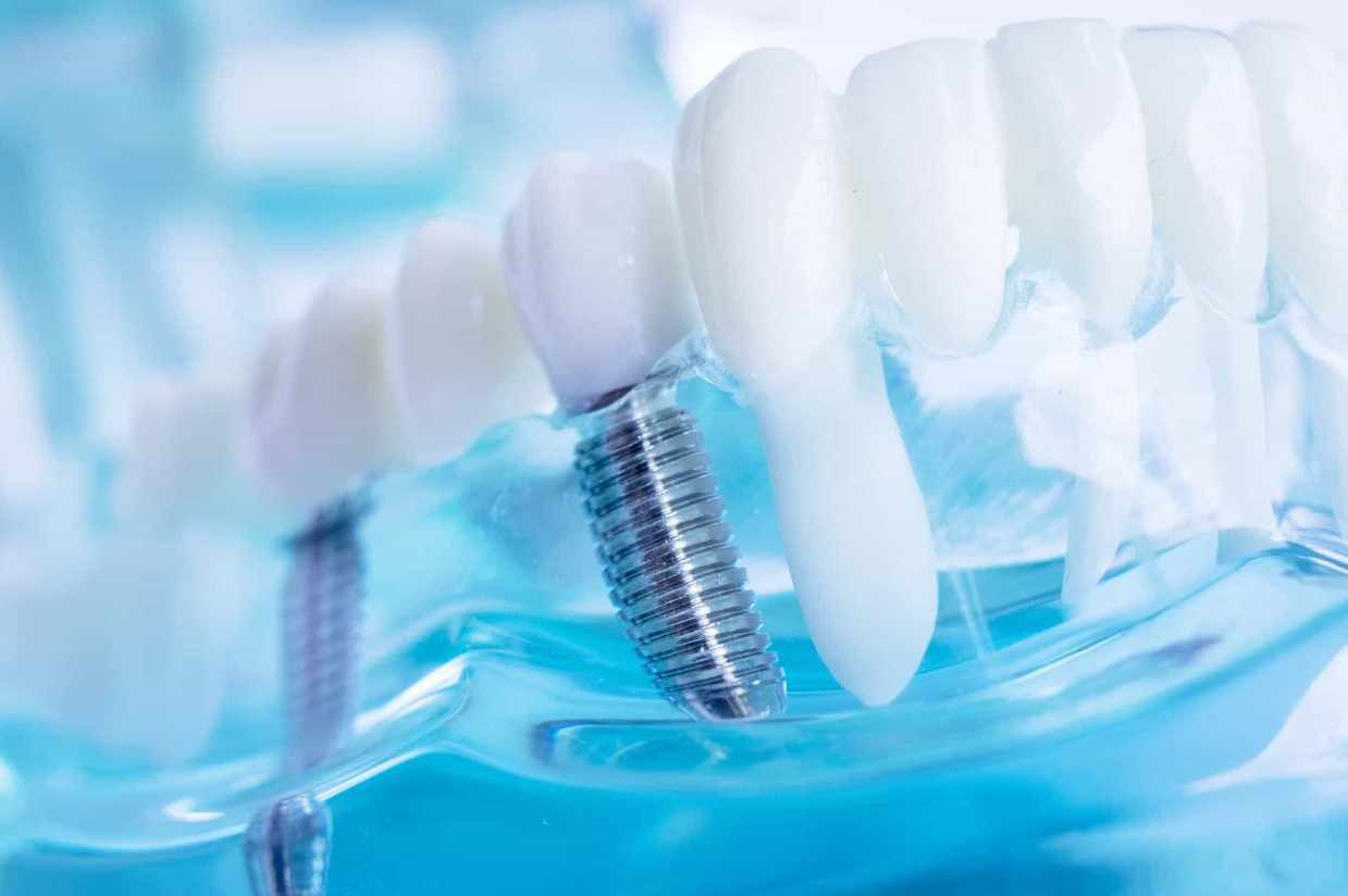 Boost Your Oral Health With Professional Dental Implant Services