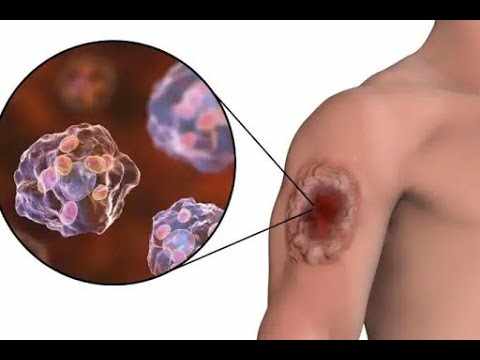 Leishmaniasis Treatment: The Neglected Tropical Disease Threatening Travel and Business