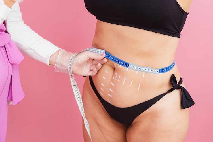 Closeup photo performing measurements on the patient's abdomen for performing an aesthetic procedure