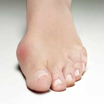 Beginning Signs of a Bunion | Sydney Bunion Clinic