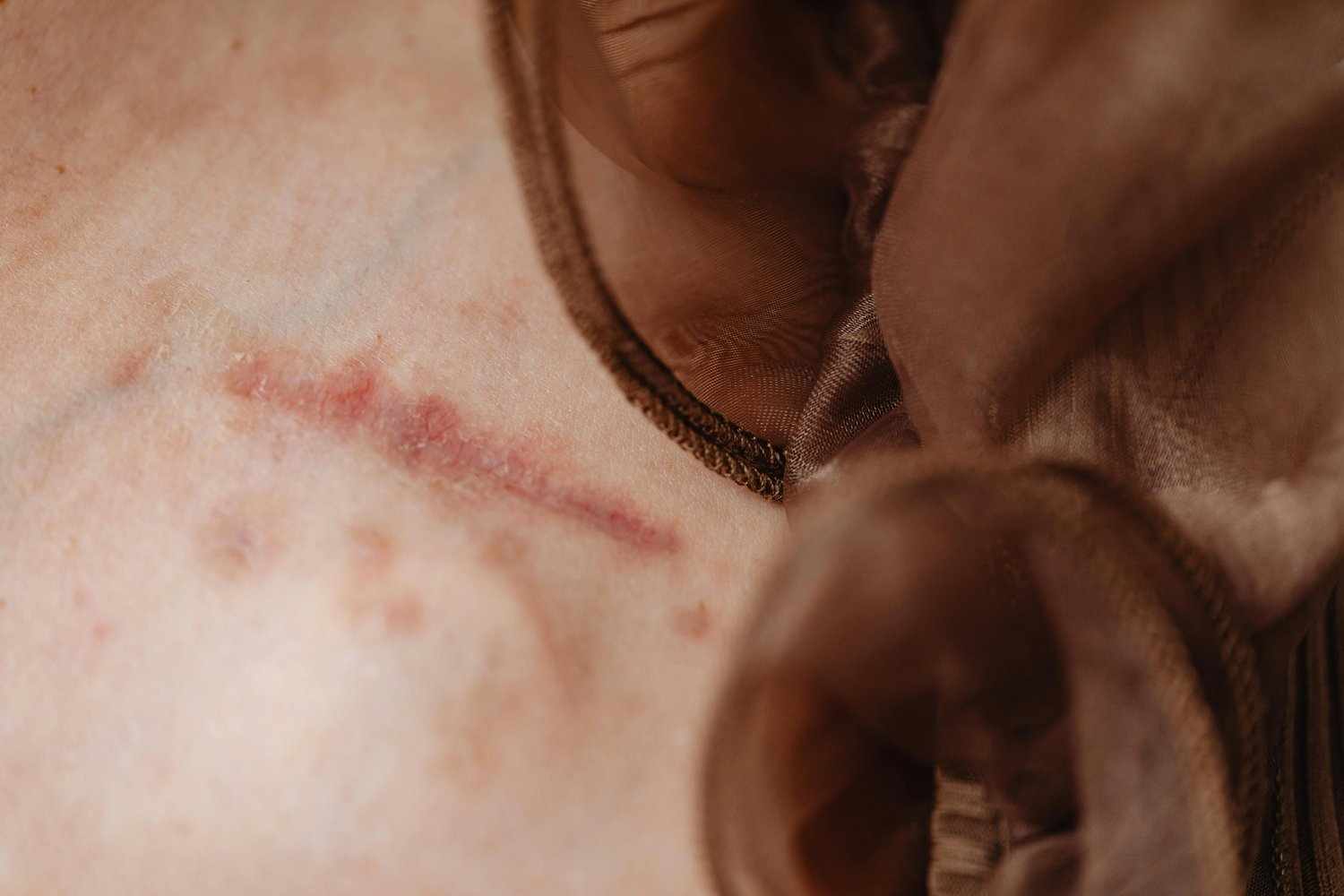 Wound Process of Healing