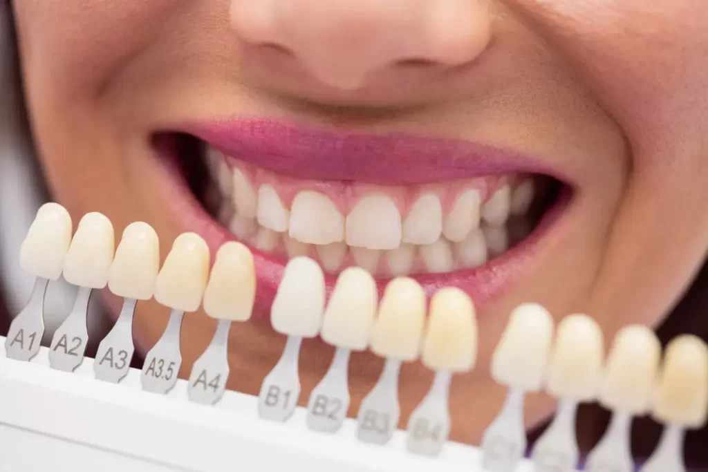Natural-Looking Dental Veneers in Fontana | The Art of Smiles Dental Group