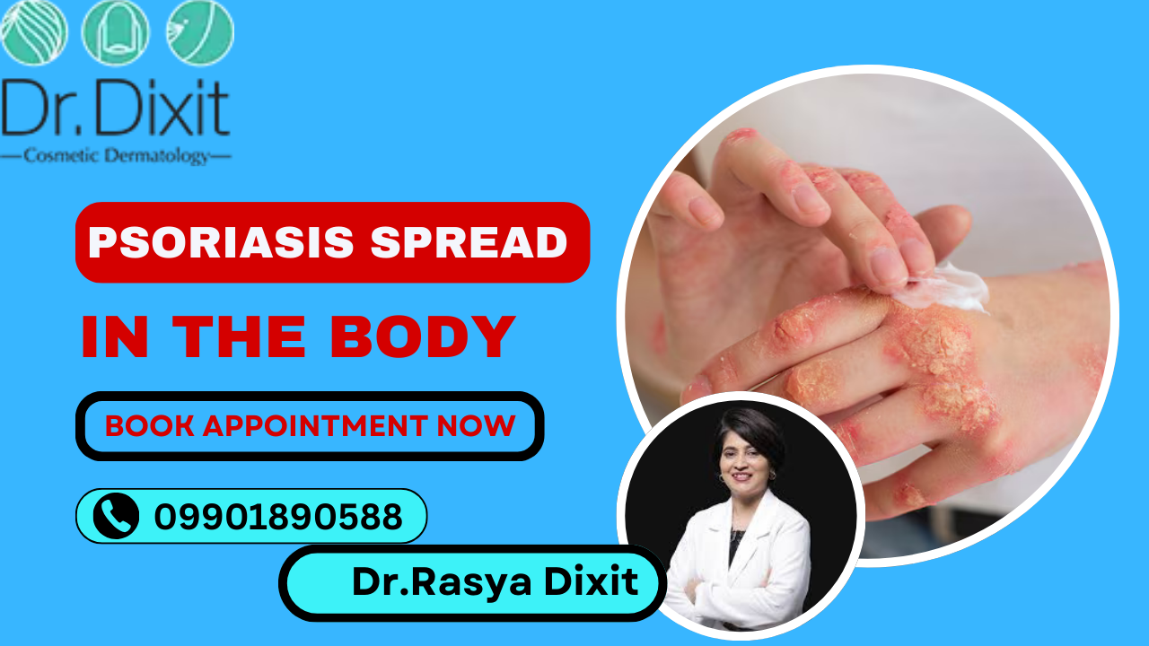 Can Psoriasis Spread In The Body?