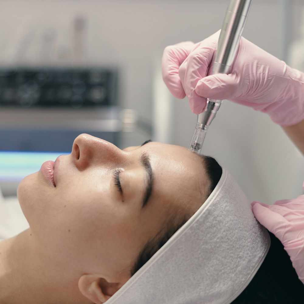 Benefits of Choosing Microneedling Skin Treatment in Burnaby
