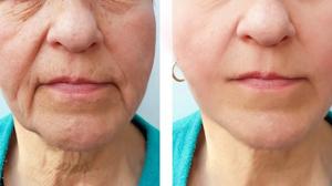 Dermal Fillers: What Do They Really Do?