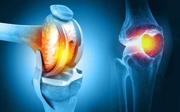 Hip Replacement Surgeon in Jaipur
