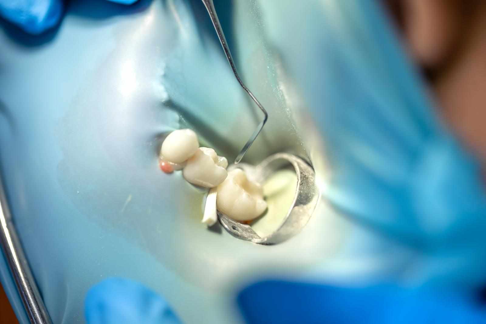Why Scallop — Shaped Drills Improve Implant Surgery: The Game-Changing Tool You Should Know About