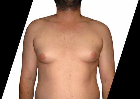 Who Qualifies for a Scarless Breast Lift in Houston?