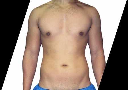 What Are the Benefits of a Scarless Breast Lift?