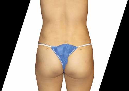Achieve a Sculpted Look with Plastic Surgery for Men Houston