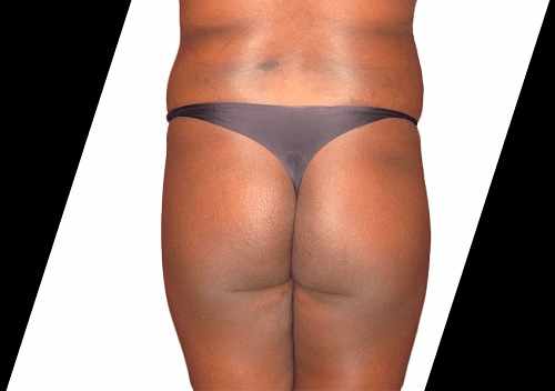 Achieve a Sculpted Look with Plastic Surgery for Men Houston