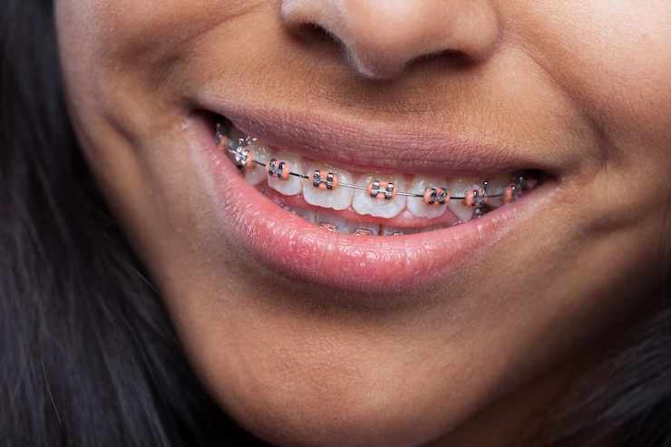 Expert Orthodontic Solutions for Straighter, Healthier Smiles