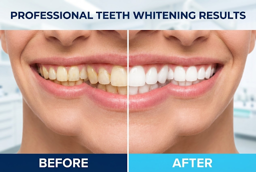 Teeth Whitening Colorado Springs: Achieve Your Brightest Smile