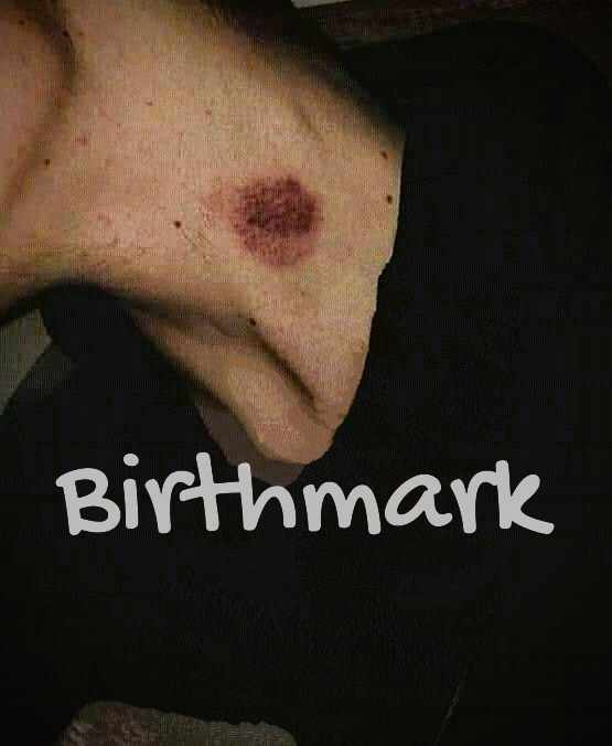 Birthmark (BL)