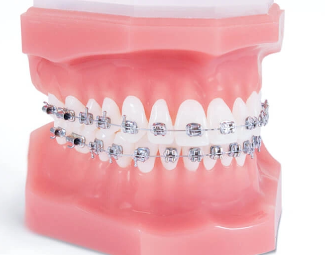 Achieve Your Perfect Smile with Invisalign in Manassas