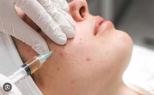 Acne Scar Treatment Birmingham