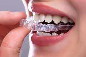 Get a New Smile through Invisalign in Sterling