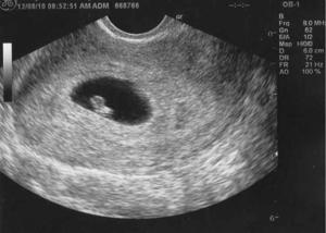 first ultrasound