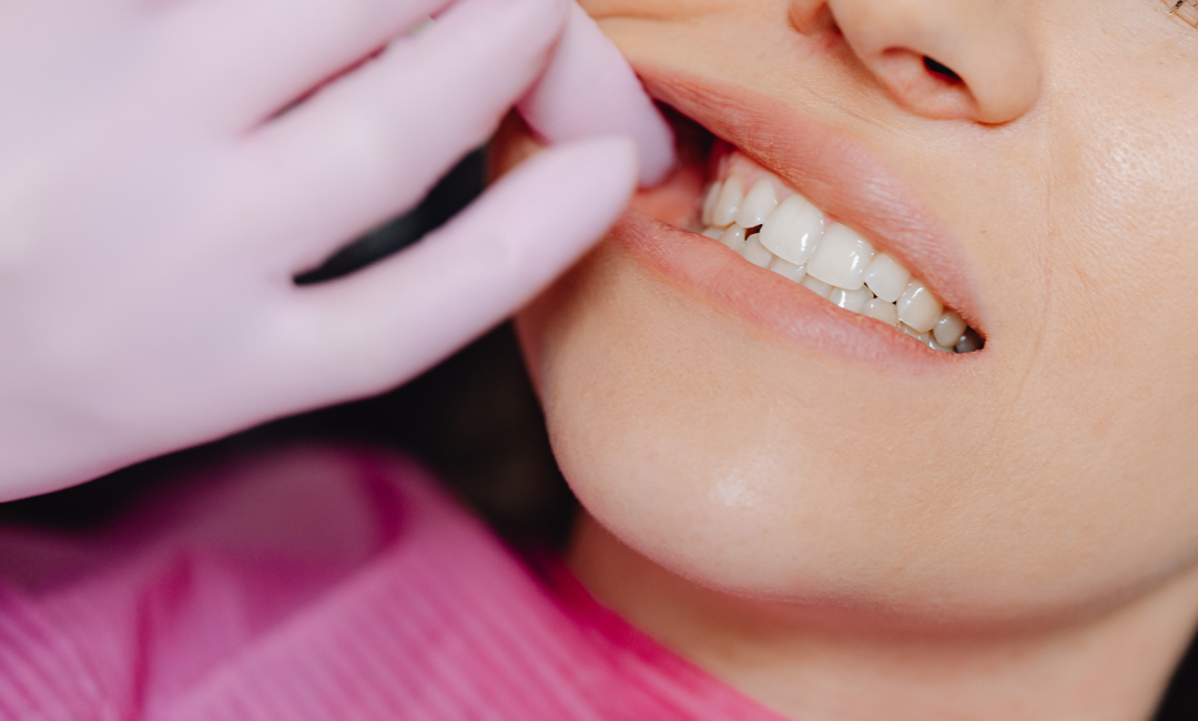 Everything Parents and Adults Should Know About Professional Teeth Whitening