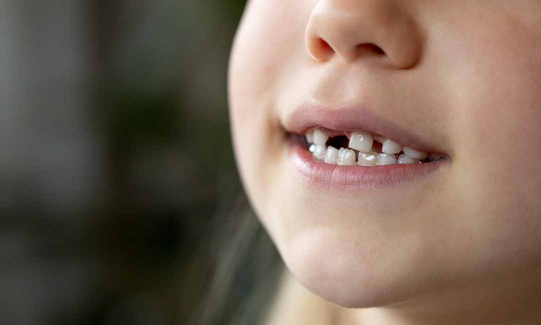 Advanced Missing Teeth Solutions in Penrith for Natural-Looking, Functional Smiles