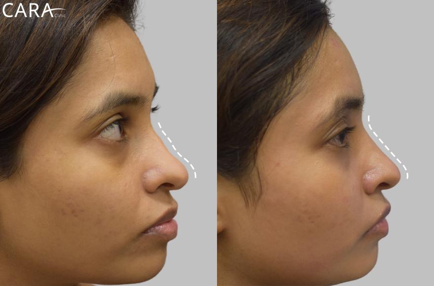 Refine Your Nose Without Surgery – Discover Non-Surgical Rhinoplasty at Cara Clinic