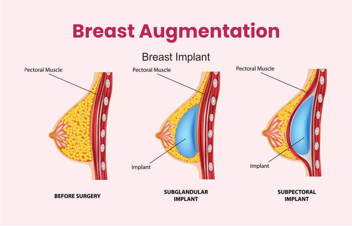 Breast Augmentation Surgery London | Breast Enlargement London